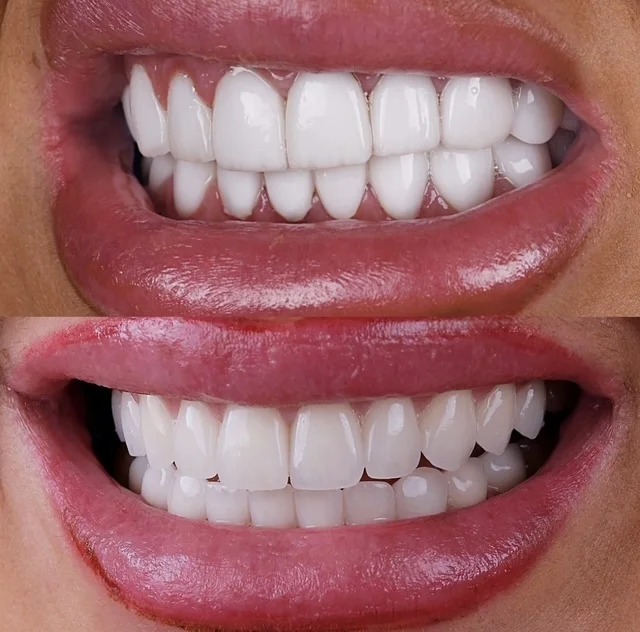 Full transformation: before treatment, the patient presented with old, discolored restorations and an uneven gum line; after treatment, modern metal-free ceramic crowns provided a highly cohesive, naturally contoured, and vital appearance.